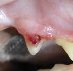 Lesion in the side of an upper premolar tooth
